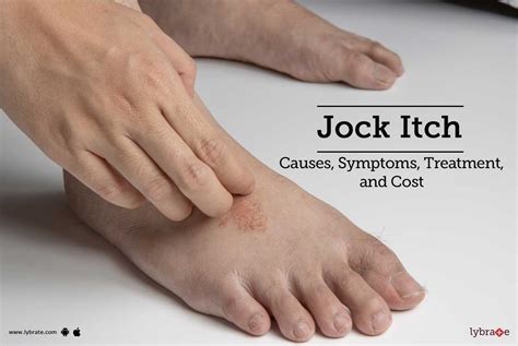Jock Itch: Treatment, Procedure, Cost, Recovery, Side Effects And More
