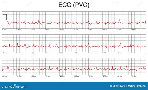 ECG Cardiogram.Cardiac Arrhythmia. Premature Ventricular Contraction ...