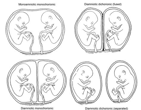 Types of Multiples - Multiples NZ