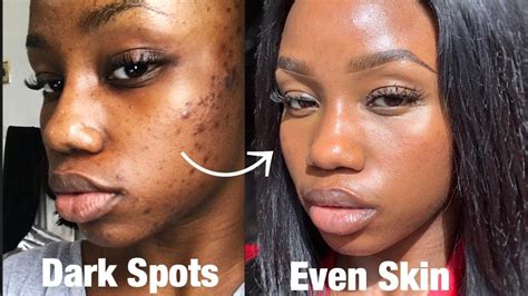 How to get rid of DARK SPOTS + HYPERPIGMENTATION FAST on Black skin ...