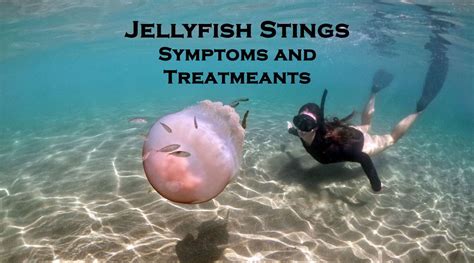 Jellyfish Stings – Symptoms, Treatment & Tips To Avoid Getting Stung