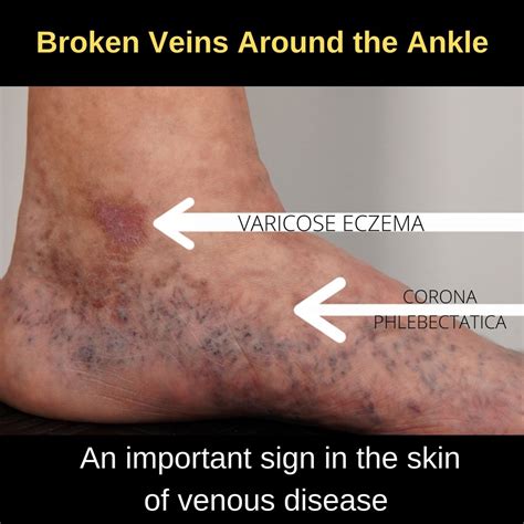 The Skin is Affected by Bad Leg Veins | The VeinCare Centre