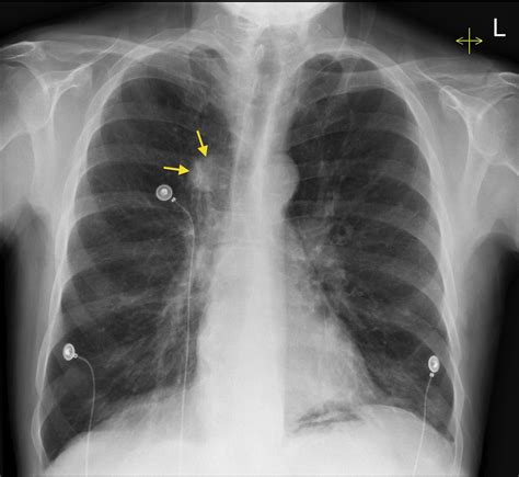 Lung cancer - CXR - Radiology at St. Vincent's University Hospital