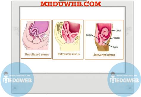 Uterine retroversion and retroflexion - Meduweb