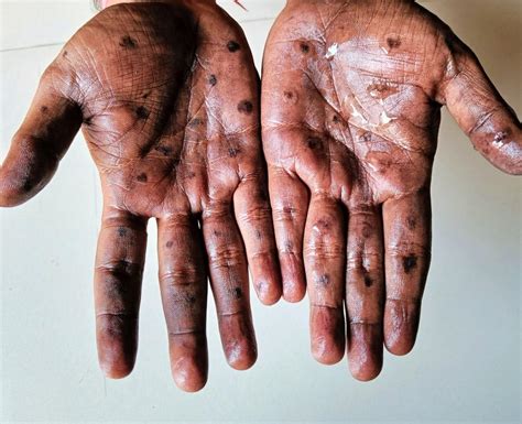 CDC: Mpox cases and deaths most prevalent in Black men | CIDRAP