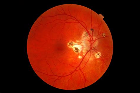 File:Presumed ocular histoplasmosis syndrome-11192007.png - Wikipedia