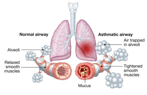 #1 Way to Prevent Asthma Symptoms — Better Breathing for Health