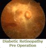 Diabetic Retinopathy in Mumbai, Opera House by Drushti Eye & Retina Centre | ID: 6924609291