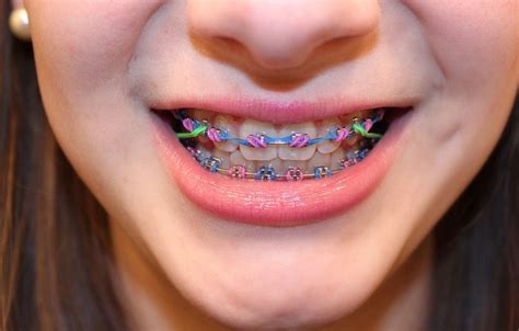 33 best images about Braces on Pinterest | Colors, Pink braces and 7 months