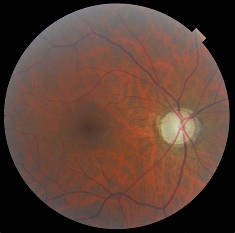 Glaucoma: Impact of a Late Diagnosis - mivision