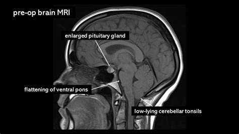 Enlarged Pituitary Gland Mri | My XXX Hot Girl