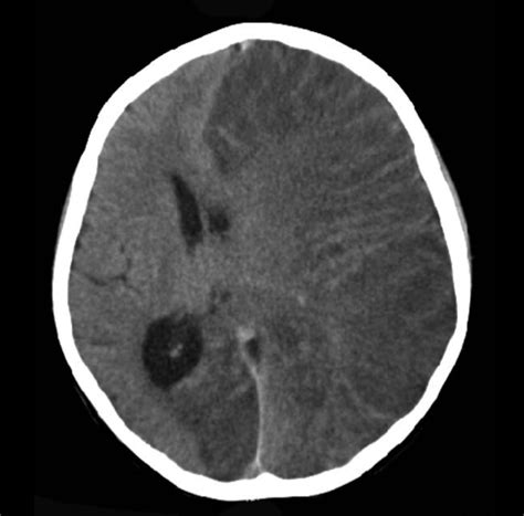 First Animal Model of Rasmussen’s encephalitis | Immunopaedia