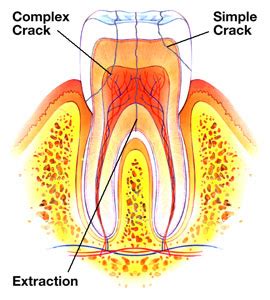 Crack Tooth Syndrome - Wake Dental Wellness : Dentist in Wake Forest