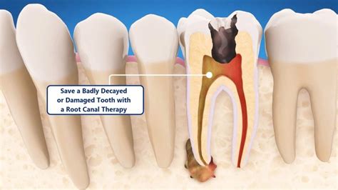 Save a Badly Decayed or Damaged Tooth with a Root Canal Therapy - Smile ...