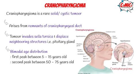 Craniopharyngioma: Diagnosis and Treatment