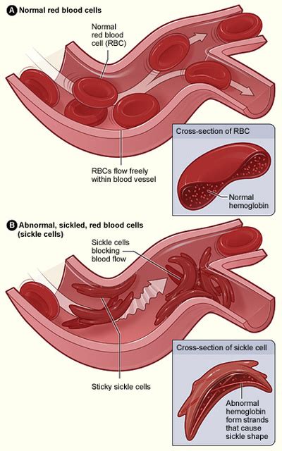 Base Substitution Mutation Sickle Cell Anemia