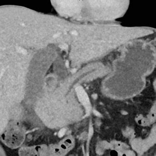 Pancreatic duct dilatation from malignant invasion. | Download Scientific Diagram