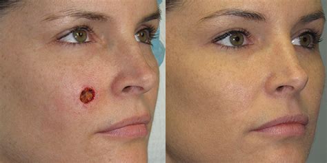 Cheek Reconstruction Gallery | Skin Cancer And Reconstructive Surgery ...