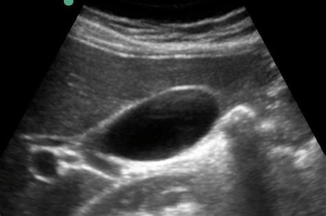 #45 - Gallbladder Pathology by Ultrasound — Staten Island University Hospital Emergency Medicine