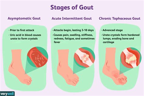 Gout: Symptoms, Pictures, Treatment, and More