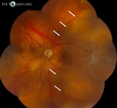 Atlas Entry - Rhegmatogenous Retinal Detachment, Macula-Off