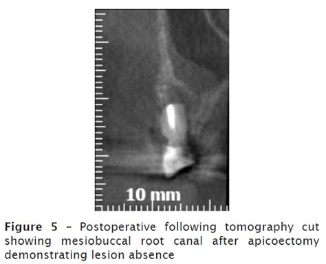 Apicoectomy after conventional endodontic treatment failure: case report