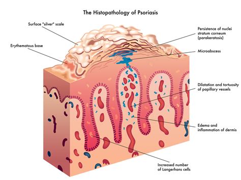 Living with Psoriasis and Psoriatic — Keto In The City