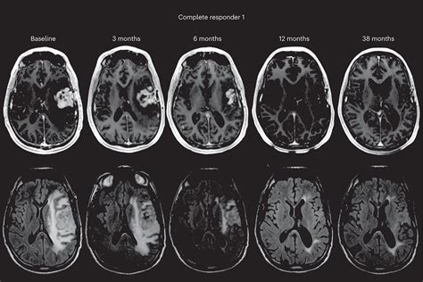 Novel treatment for recurrent glioblastoma shows promising results ...