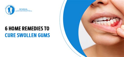 6 Home care tips to cure swollen gums - Senthil Dental Clinic