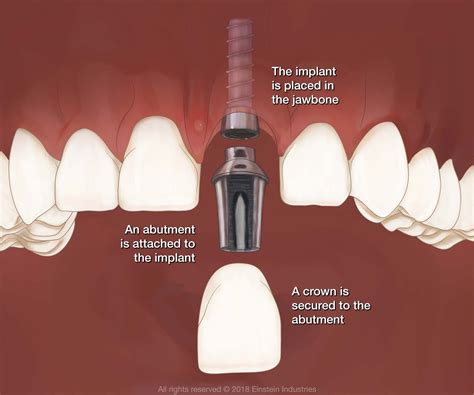 Three distinct parts make up an implant-supported restoration, replacing a tooth from root to ...