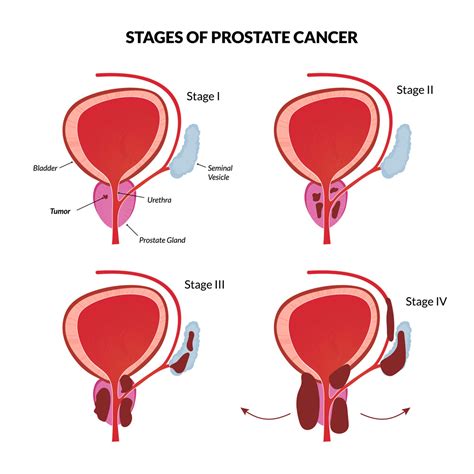 Prostate Cancer Stages Symptoms - CancerWalls