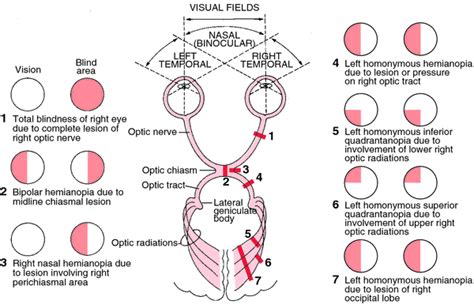 Hemiopia | definition of hemiopia by Medical dictionary