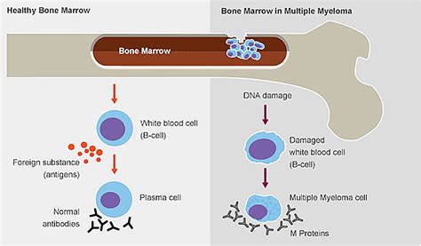 Multiple Myeloma -Symptoms, Causes, Risk Factors & Complications