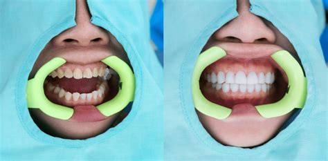 Veneers: Pros and Cons | Northern Westchester Dental Care