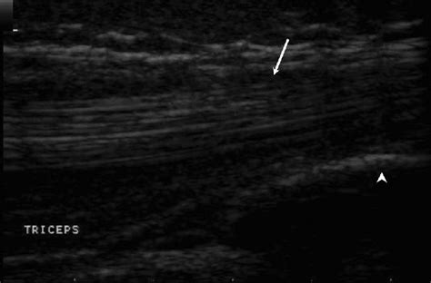 Olecranon fossa. Longitudinal scan through the elbow, showing the... | Download Scientific Diagram