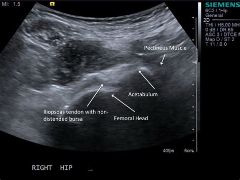 Iliopsoas Tendon Ultrasound