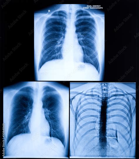 X-Ray Image Of Human Chest Stock Photo | Adobe Stock