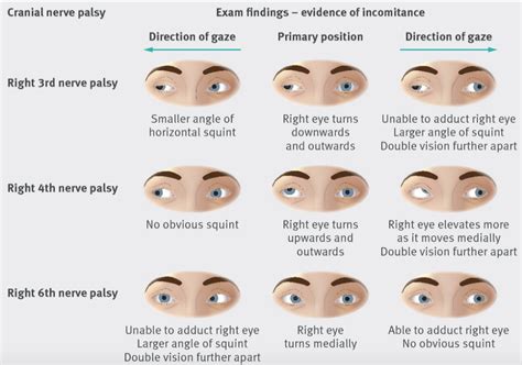 Re: Cranial Nerve III Palsy(Oculomotor nerve palsy) - 12 신경질환의 탐구 - 치료적 ...