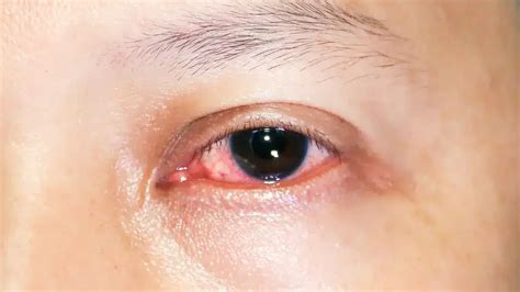 A Complete Guide to Keratitis Treatment and Prevention