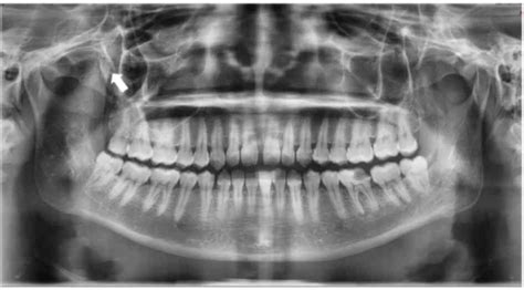 Osteochondroma of the coronoid process: A case report and review of the ...