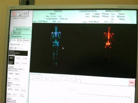 Nuclear Bone Scan for Prostate Cancer | HubPages