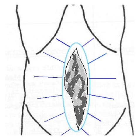 Elliptical incision, away from the granulating surface of the open... | Download Scientific Diagram