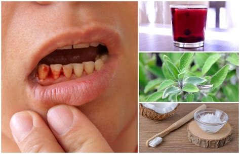 9 Best Home Remedies To Get Rid Of Gingivitis | Gingivitis remedies ...