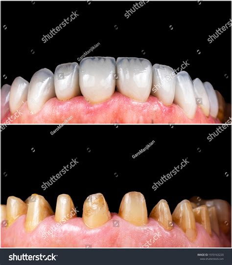 8 Single Tooth Implant Before After Images, Stock Photos & Vectors ...