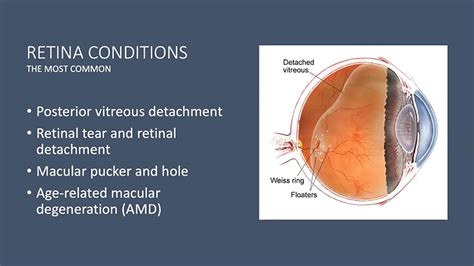 VIDEO: Demystifying Retinal Diseases - UCSD-TV - University of ...