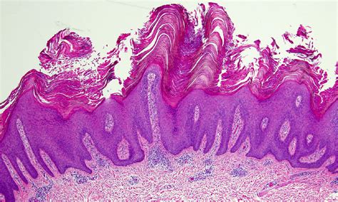 Epidermal nevus