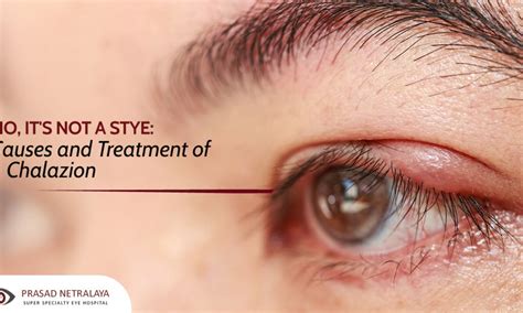 Home Eye Stye Treatment Chalazion Treatment Eyelid