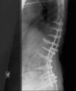 Pedicle Subtraction Osteotomy | Neupsy Key