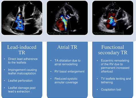 Frontiers | Tricuspid Regurgitation in Left Ventricular Systolic Dysfunction: Marker or Target?