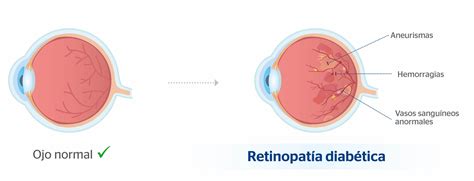 Retinopatía diabética: qué es, síntomas y tratamiento | Clínica Baviera